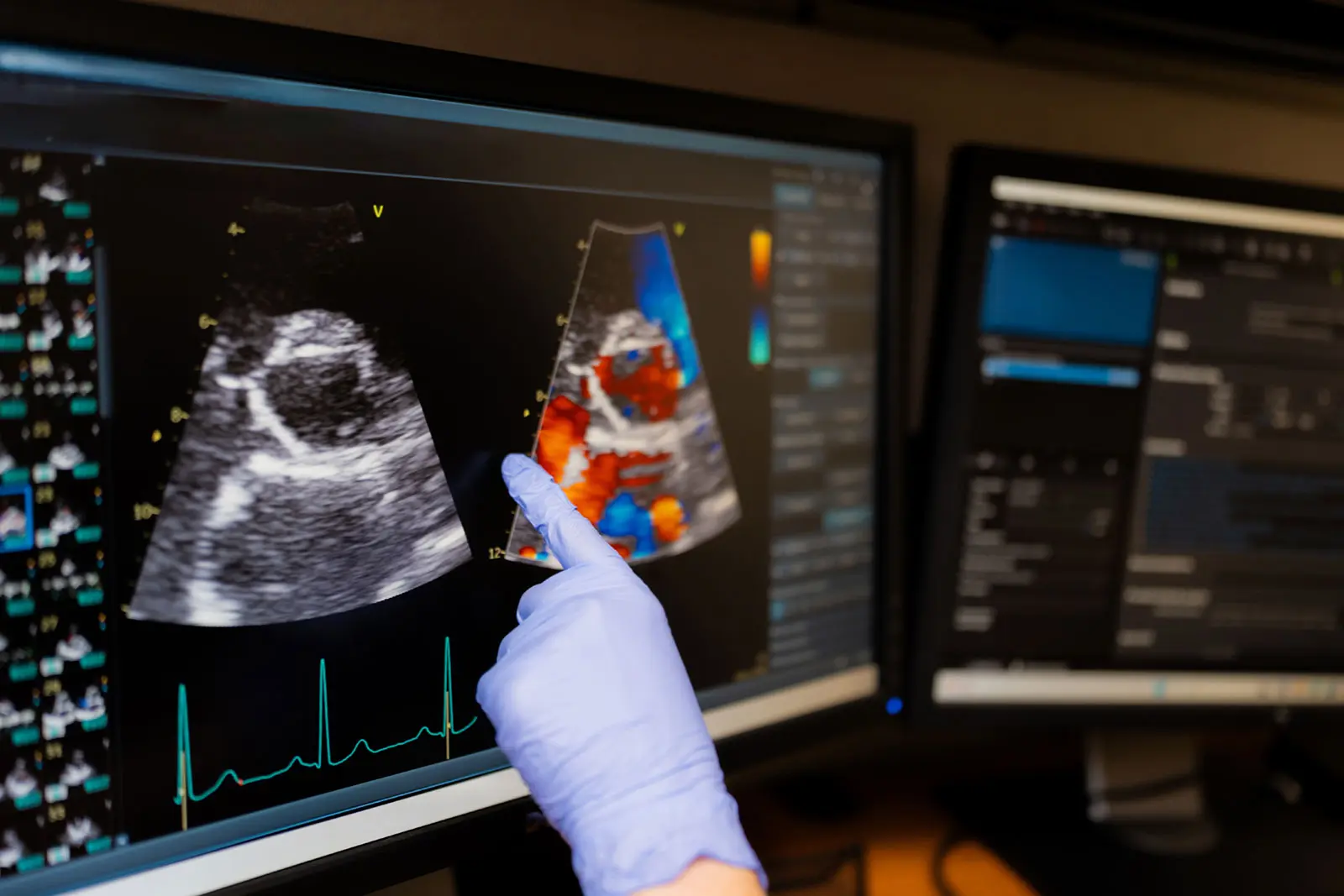 A gloved hand points to a color Doppler echocardiogram on a monitor, with an ECG tracing running beneath the image.